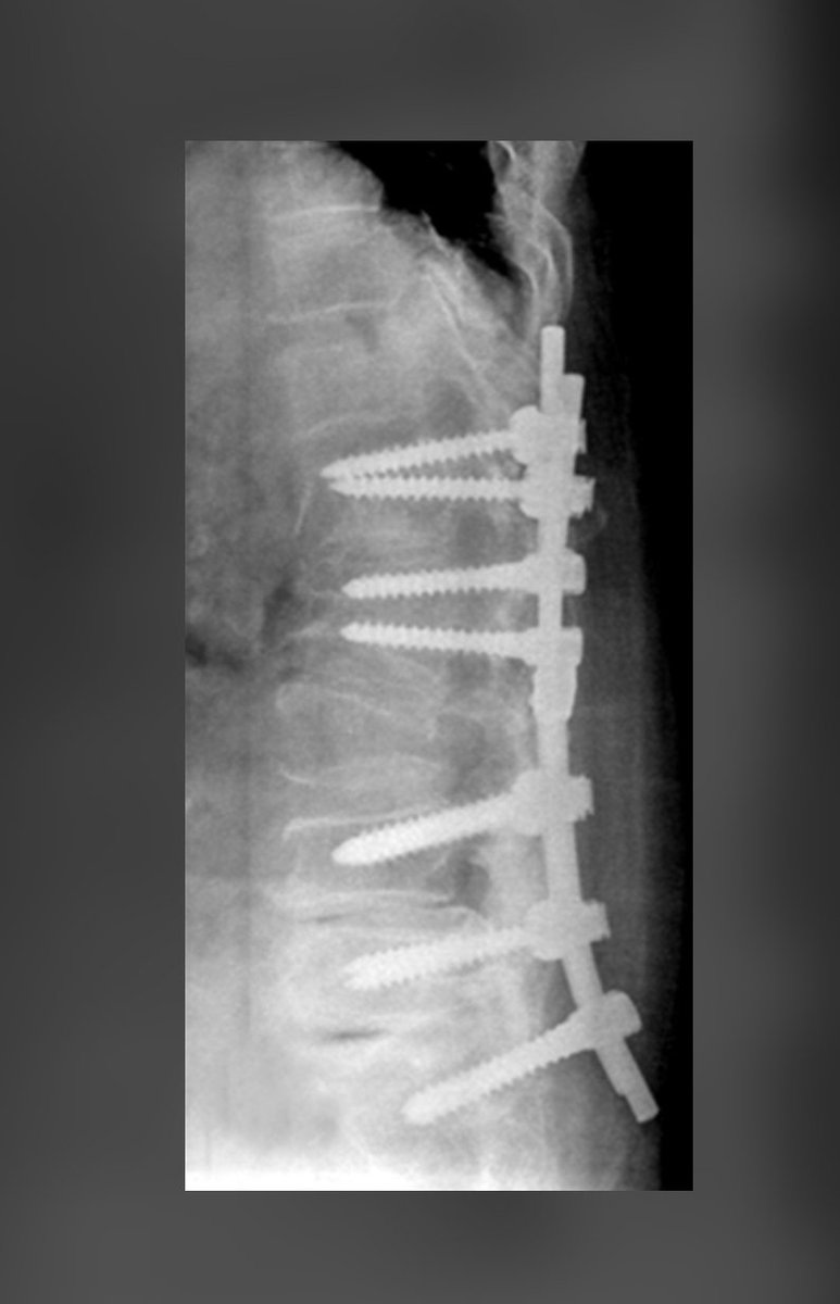 SincanCikBilgi_'s tweet photo. Omurgasında 22 vida taşıyan bir üniversite öğrencisi, tüm sağlık risklerine ve zorlu koşullara rağmen cezaevinde tutulmaya devam ediyor. Cezaevi ortamı, bu derece ciddi bir omurga rahatsızlığı olan bir gencin sağlığını her geçen gün daha da tehlikeye atıyor.
+++
@adalet_bakanlik
@ADLITIPKURUMU 
@cemre_birand2 
@albayrak_kemal 

HastaTutuklu ÖğrenciMeryem