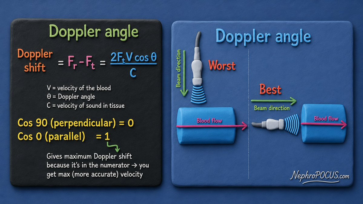 NephroP's tweet photo. Tweet no. 13 #echoboards #Physics thread.
Doppler equation - memorize this ‼️
⭕️The Doppler shift is the difference between the frequency transmitted by the transducer and the frequency returning from moving blood cells.
Simple concept:
🩸 Faster blood flow → Bigger Doppler shift → Higher measured velocity.
🩸 Slower blood flow → Smaller Doppler shift → Lower measured velocity.
Positive vs. Negative Doppler shift
➡️ Blood moving toward the transducer → Returning frequency is higher than transmitted → Positive Doppler shift (flow toward the probe).
⬅️ Blood moving away from the transducer → Returning frequency is lower than transmitted → Negative Doppler shift (flow away from the probe).
✅ 0° (beam parallel to flow) → cos 0 = 1 (= max numerator) → Maximum Doppler shift → Most accurate velocity.
✅ 90° (beam perpendicular to flow) → cos 90 = 0 → No Doppler shift → Velocity cannot be measured.
✅ As the Doppler angle increases, cos θ decreases, so the Doppler shift becomes smaller and the measured velocity is underestimated.
⭐️ Bottomline: Parallel angle is the best for Doppler.
In #echofirst, it is not recommended to use 'angle-correct' feature on the machine.
Instead, obtain a view that makes the beam as parallel to blood flow as possible. #Anatomy is the 🔑