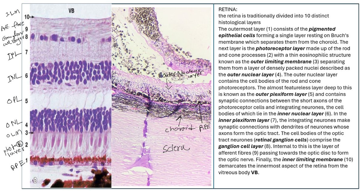 pathognosis22's tweet photo. Recently came across a case of #uveal #melanoma, noted some important histological landmarks of #ocular #pathology, thought worth sharing #pathology #pathognosis #orbit #eye #histology https://t.co/U2FB4hP5BG