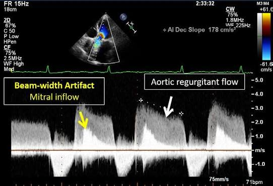 RitikaTuliMD's tweet photo. CardioNugget™: 

Beam-Width Artifact on CW Doppler

💡 Beam-width artifact = Doppler signal contamination from structures outside the intended ultrasound beam.

In this image:
The CW cursor is aimed at the aortic regurgitation (AR) jet.
Because CW Doppler has a finite beam width (not an infinitely thin line), it also intercepts the mitral inflow (E wave) adjacent to the LVOT.

The machine records both high-velocity AR flow and mitral inflow simultaneously.

Fix: Reposition the transducer or change the imaging window so the adjacent flow is excluded.

#CardioNuggets #MedEd #EchoBoards