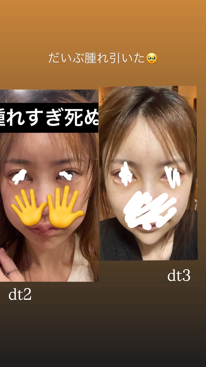 gaogao_inu's tweet photo. 目頭切開の抜糸もおわり、バッカルファット腫れはこんな感じです、！
引いてきました😊 #バッカルファット #フェイスライン #輪郭 #ダウンタイム #dt4 #インスタストーリー #整形垢 #整形 #経過記録 #目頭切開 #抜糸後 https://t.co/AbPNN3c3PD