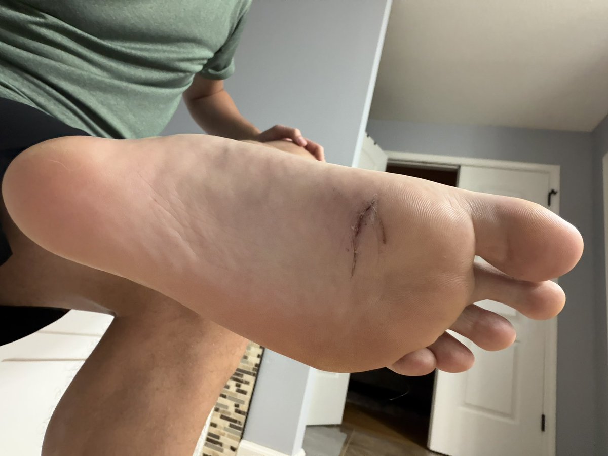 BL1982x's tweet photo. Stitches came out today. Healing up well.
#size15 #size15s #bigfeet #size15feet #bigfoot https://t.co/ZxO5LPl6gt