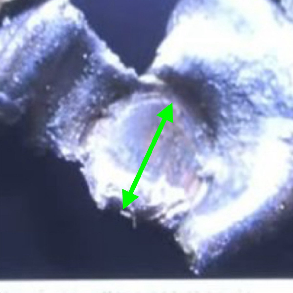yoshithepatriot's tweet photo. The .286–.301” range was for a deformed jacket fragment (not an intact bullet). High-velocity impact with pointed soft point rounds (especially on bone) deforms, tears, or compresses the bullet, so measured fragments are often undersized compared to the standard .308”.

The expert noted it was still consistent with various 30-caliber class firearms.