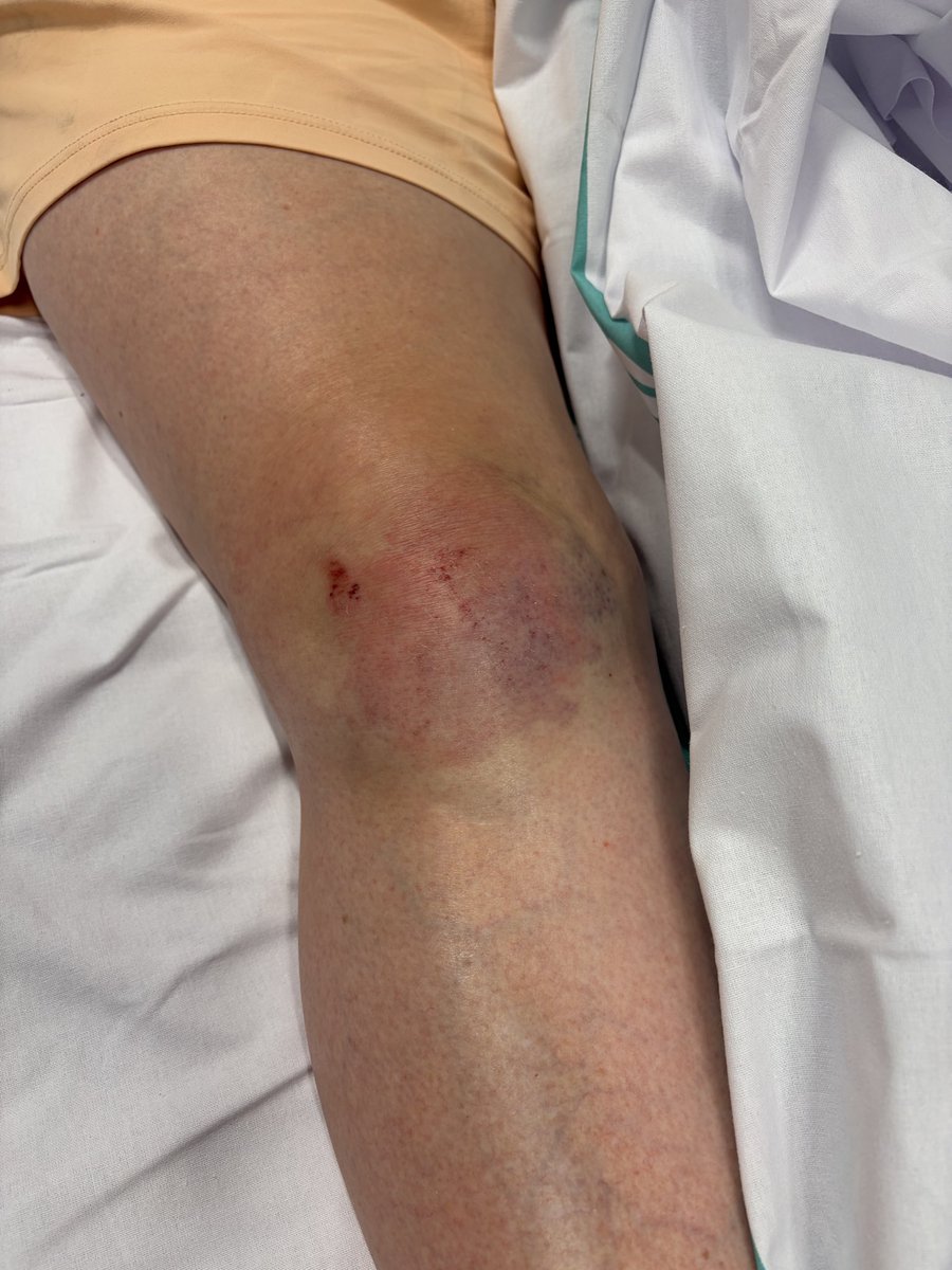 JMMandingorra's tweet photo. Así mismo agradecer a Carlos y su compañero del #061 de Aragón por su atención y posterior traslado al hospital de #Alcañiz . Una vez hechas las pruebas, resultado: contusión en la rodilla y fractura de la falange del dedo meñique, reposo y analgésicos. https://t.co/savUBAGJDC