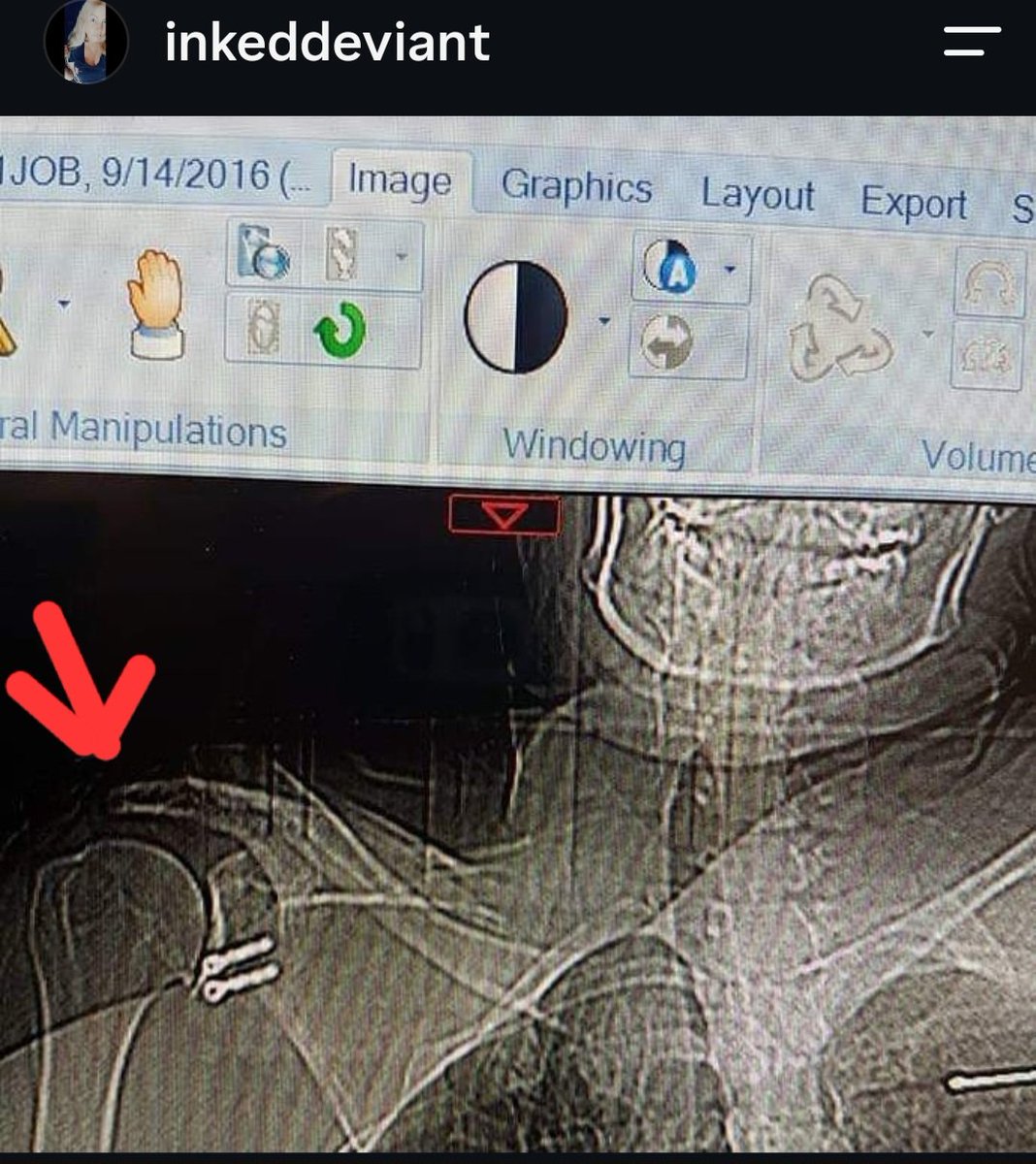 InkedDeviant's tweet photo. Well. This Is Me, Currently. 

After 3 Shoulder Reconstructions, I'm HOPING Its Not A Hardware Fail...Last Surgery Was A Laterjet Repair - 8 Hours Of Surgery Over 10 Years Ago, Screws, Bone Block.

Monday Will Call My Family Doc &amp; Start There..🙄
I'm In Fck'n Agony. 
#InkedOut https://t.co/SveGvMekm5
