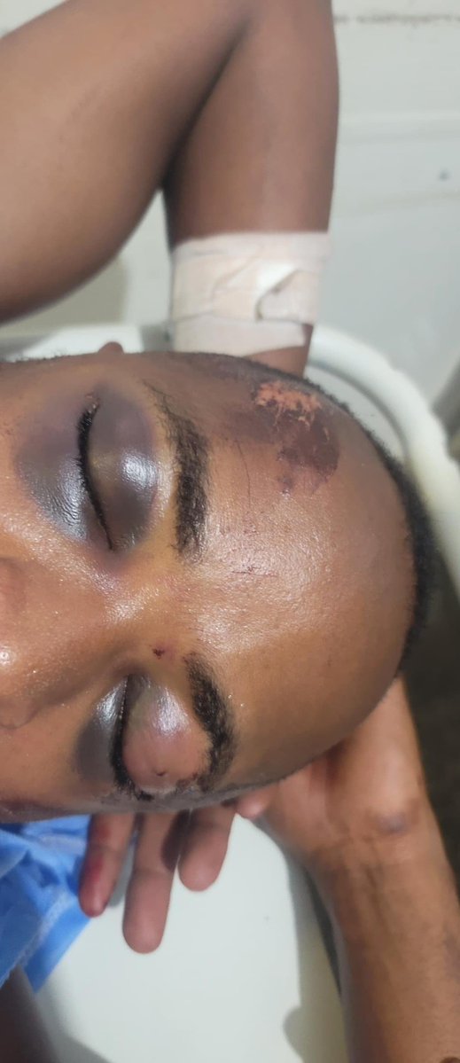 BazongereTonny's tweet photo. Received at A&amp;E after a very bad motor vehicle accident. What do you see? https://t.co/jf31Q0nSTG