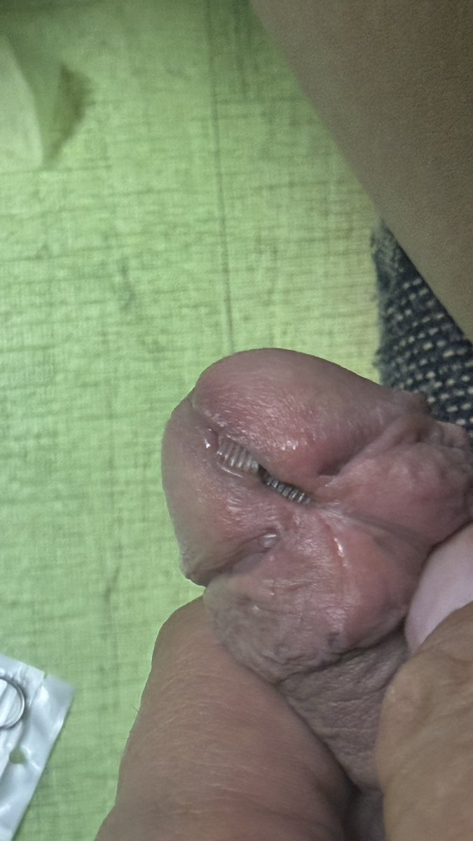 ad2k0001's tweet photo. 밤새 피가 멈���지 않아 힘들었다...
#subincision https://t.co/oUsGnEKdia