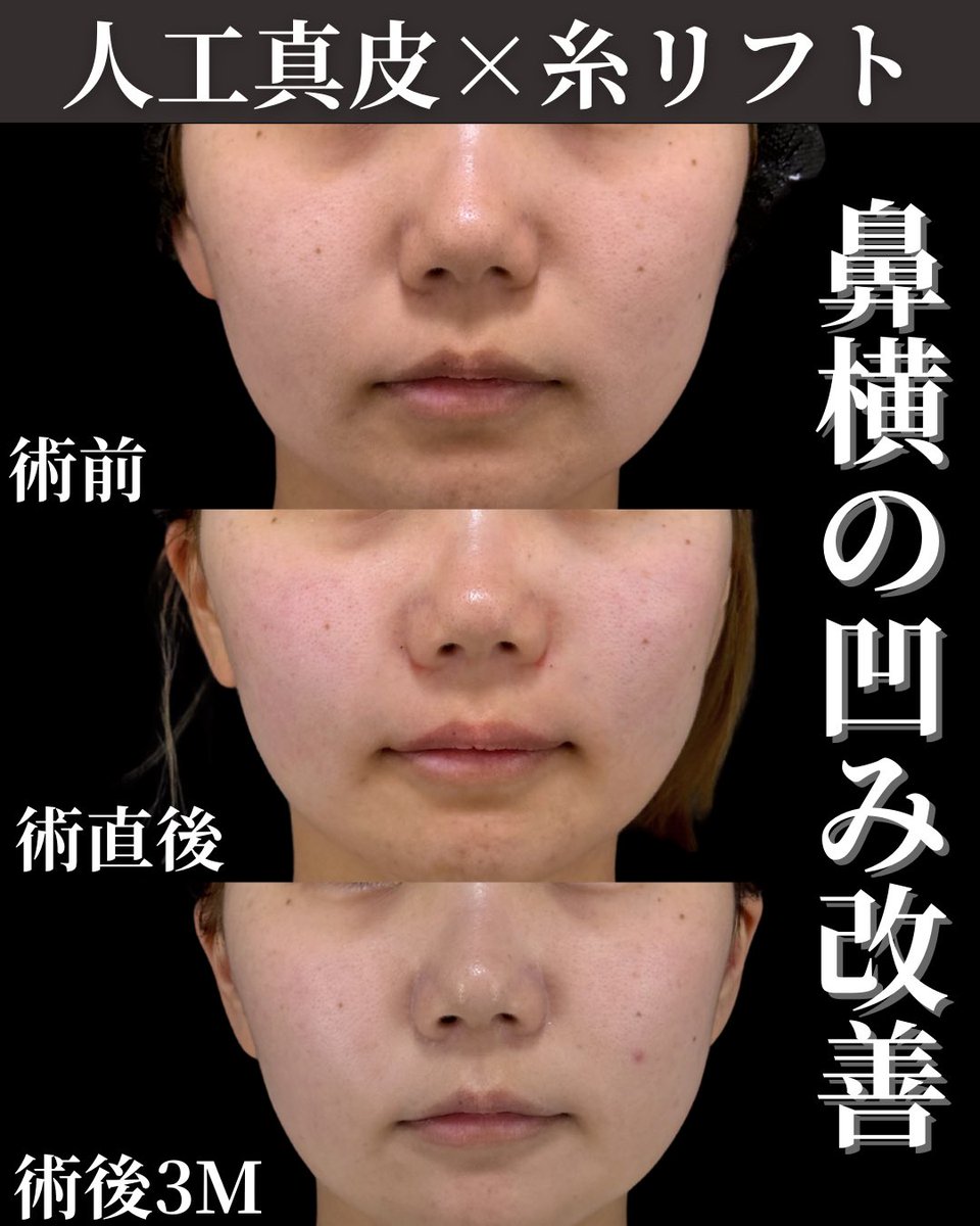 dr__kinopy's tweet photo. 貴族手術(人工真皮)は腫れてるだけ、すぐ吸収されるだの色々な意見が散見されますが。

一つ言えることは＂変化は出ます＂

変化が出ない施術をやるわけないじゃないですか。それは詐欺です。

そしてナチュラルさが売りなので、馴染みが良いものである必要があります。馴染み悪いものを動く場所に置く方がどうかしてます。

経過が気になるのならご自身もやってみれば良いではないですか？