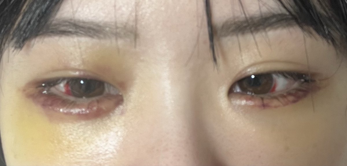 Ri2222R's tweet photo. DT1週間

二重復活‼️👀
結膜下出血と紫の内出血が酷くてこれはまだ人に会えないなあどうしよう https://t.co/tRKrYkK9NY