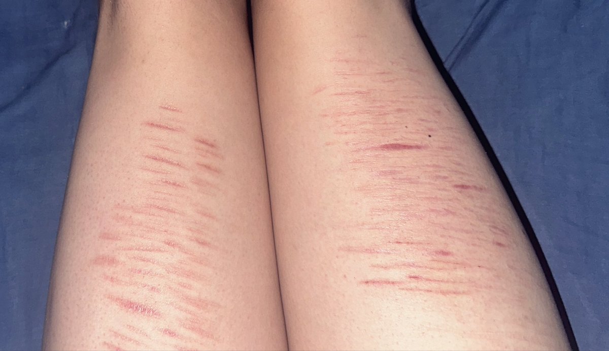 Inexplicablemns's tweet photo. the scars look better after 1 month ?#scars #scar #selfharm #sh #cut https://t.co/HbHNxSAe8X