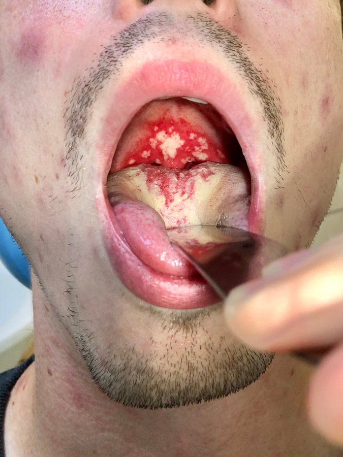 ModReflexion's tweet photo. POR QUÉ EL VIH AÚN NO TIENE CURA

¿Alguna vez te has preguntado por qué el VIH es tan difícil de vencer?

Este hilo explica - en términos simples - cómo el VIH infecta el cuerpo y por qué sigue siendo tan difícil de curar.

Un hilo https://t.co/Y7Bc8bons9