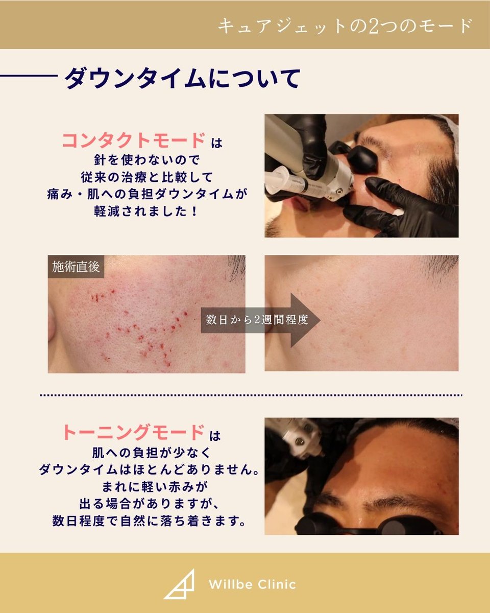 willbeclinic's tweet photo. ダーマペンやポテンツァを受けても、改善しないニキビ跡。

実はその原因、肌表面ではなく「皮膚の奥の癒着」かもしれません。

クレーター治療には、原因に合わせた治療選択が重要です。

そこで注目されているのがキュアジェット。

仕組みをまとめました👇 https://t.co/9urSEQ1PwE