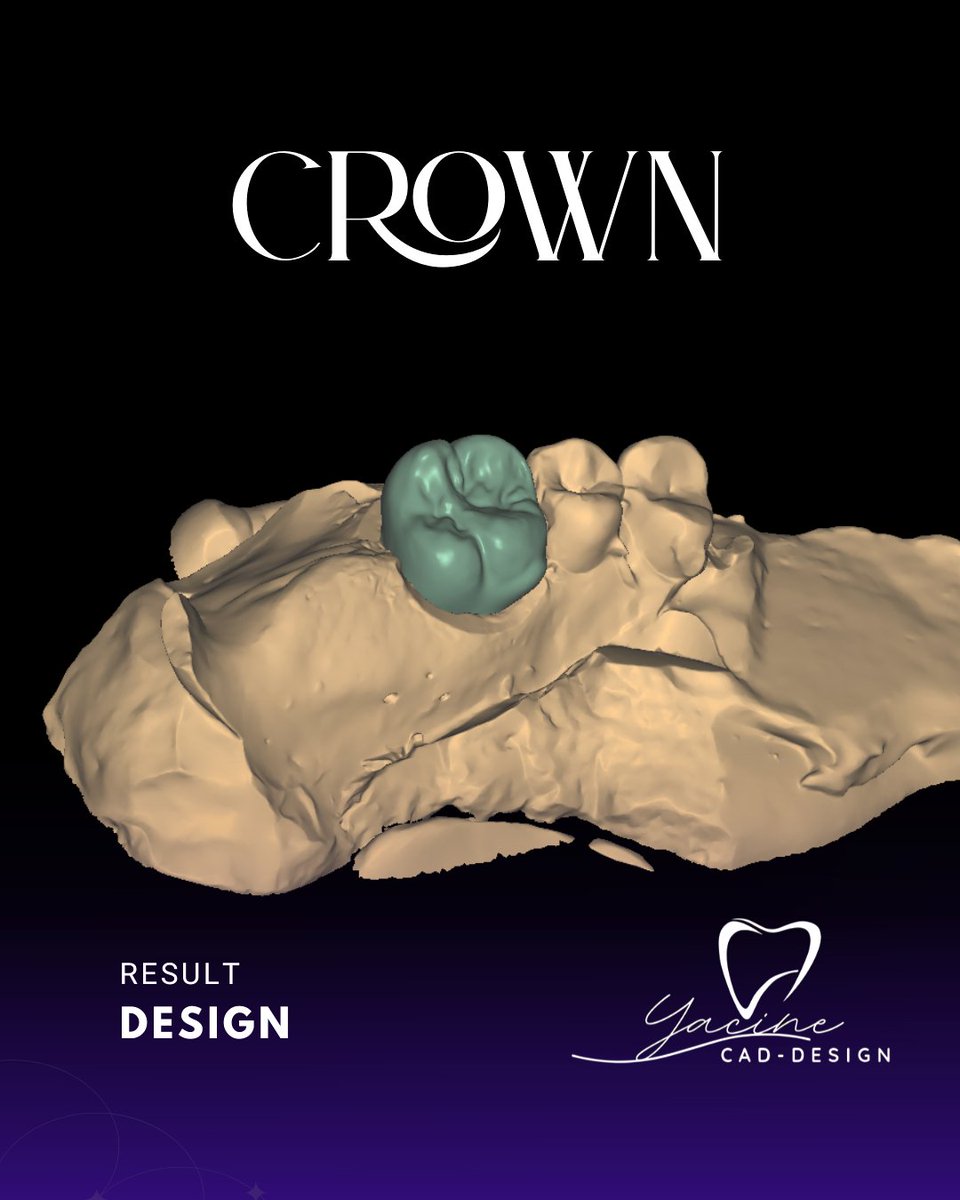 dentacine's tweet photo. Single crown design in Exocad, optimized for precise fit, functional occlusion, and natural esthetics. Every restoration is designed with milling efficiency and clinical predictability in mind.

#Exocad #DentalCAD #DigitalDentistry #CADCAM #DentalLab #CrownDesign https://t.co/gpqIQKiql3