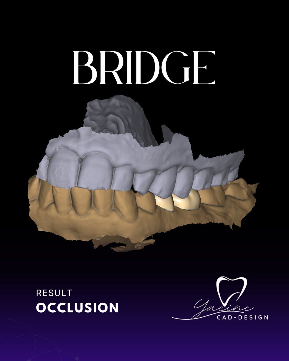 dentacine's tweet photo. Bridge design completed in Exocad with a focus on precision, proper occlusion, and natural esthetics. Designed for a predictable fit and efficient manufacturing workflow.

#Exocad #BridgeDesign #DentalCAD #DigitalDentistry #CADCAM #DentalLab #DentalTechnology https://t.co/x69EbzfFNT