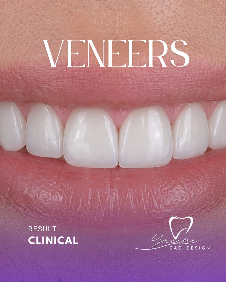 dentacine's tweet photo. Veneer design completed in Exocad, balancing natural esthetics, symmetry, and functional occlusion. Every case is designed with precision to help achieve a predictable clinical outcome.

#Exocad #Veneers #SmileDesign #DentalCAD #DigitalDentistry #CADCAM #DentalLab https://t.co/gtehYf5GIP