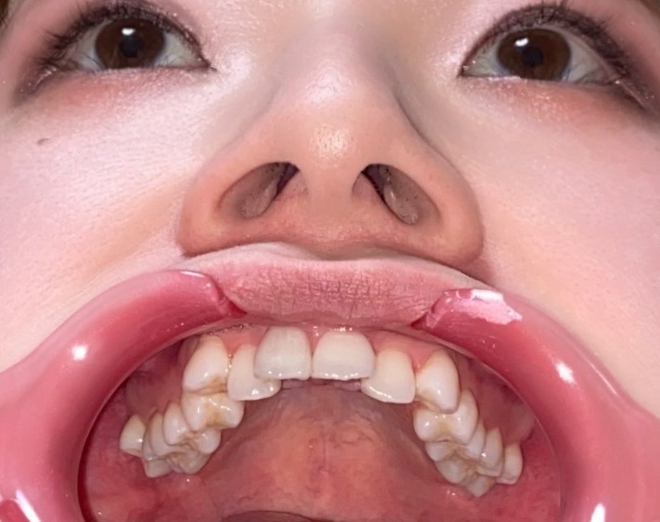 pic_teeth's tweet photo. 口腔内写真では、この前歯部あおりの時にへ鼻を入れて撮影することがあります。

女子等は鼻の穴見える撮影に抵抗あるかもしれませんが、この方のように鼻毛処理すると良いかもしれないですね。

モデル撮影の写真ですので自由に利用okです

#開口器 
#口腔内写真 
#アングルワイダー
#著作権フリー https://t.co/vXvRq6JPtI