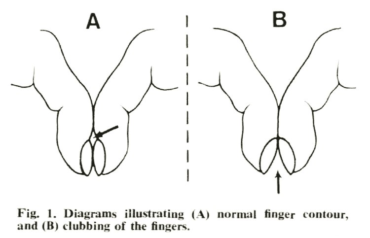 aproko_doctor's tweet photo. Na that extra blood flow dey cause the swelling that looks like what you get in this picture. How do you check if you have it? 

Put the nails of your two index fingers together back to back. You should see a tiny diamond shaped hole of light between them like this 

A is normal https://t.co/5fi575i26B
