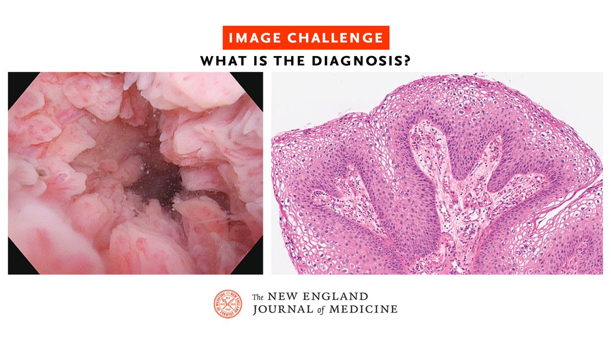 NEJM's tweet photo. A 42-year-old man on prolonged immunosuppressive therapy for chronic graft-versus-host disease after stem-cell transplantation for acute lymphoblastic leukemia presented to clinic with a 2-week history of urinary frequency and weak stream. Read the full case details and submit your answer or see how others responded: https://t.co/vk73MHzLLH