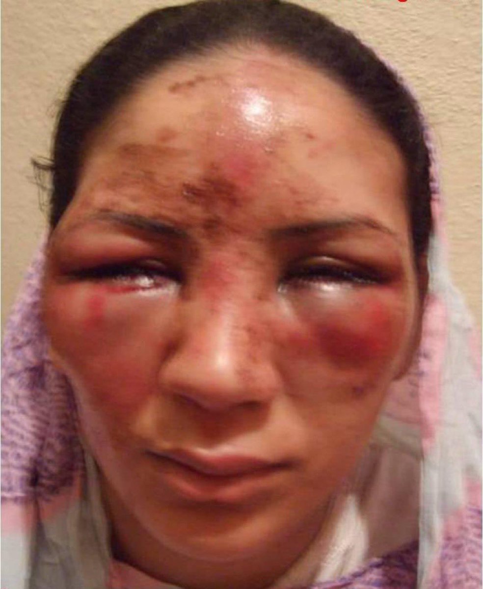 soupalestina's tweet photo. 🇲🇦💥🇪🇭 CHOCANTE. IMAGEM FORTE!

Uma mulher saaraui foi violentamente agredida no rosto por forças da ocupação marroquina.

A repressão nos territórios ocupados de Saara Ocidental segue deixando testemunhos de violência e abusos. Solidariedade às vítimas e à @CODESA_SO, que documenta essas violações.

Chega de impunidade. Liberdade para os presos políticos saarauis.