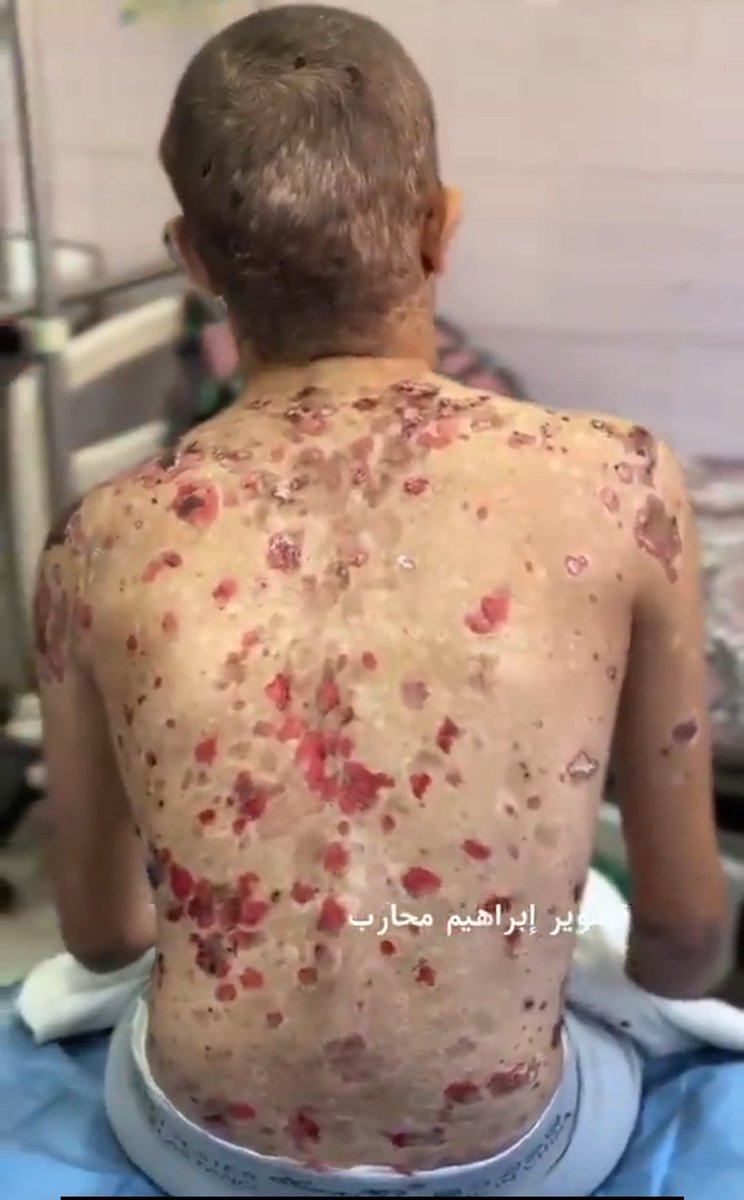 AHMED_ABUHAMAD_'s tweet photo. شاهدٌ حيّ على جريمة لا تغتفر :

أنظروا ماذا تفعل صواريخهم بأجسادنا .. تنهش الجلود، وتترك ندوباً وقروحاً تصرخ بظلم عالمٍ يرى احتراقنا ويصمت .

إن لم تُحرككم أجسادنا المشوهة، فمتى تستيقظون ؟ https://t.co/iOt8Iuk3ss