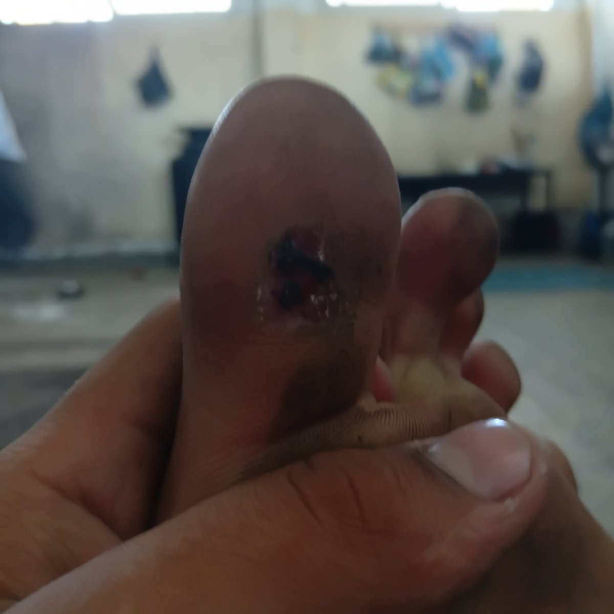 RozeatG's tweet photo. My son has a foot wound that's getting worse and needs treatment, but we can't afford it. We're appealing to kind-hearted people for help; every contribution makes a difference. 💔💔🤲

https://t.co/PoTNVpFiJv https://t.co/mPrh98Utk4