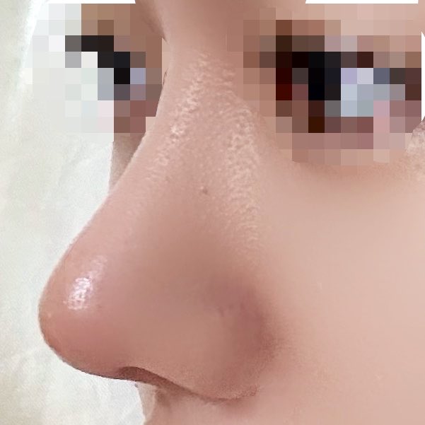 nannimonainida's tweet photo. dt6ヶ月経過💉

周りからも馴染んできて鼻綺麗って褒めて貰えることが増えました✨( >▽<)✨🎵🩷

@auraps2024 

 #整形垢 #鼻フル #鼻整形 https://t.co/2oA8Nji00e
