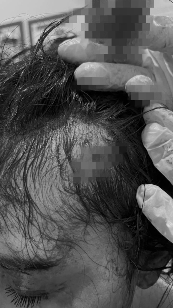 inspladusseng's tweet photo. izin bantu up kasus ini.

ini kronologi berdasarkan pengakuan abangnya:

ada cewek yang kerja di bogor sering di ganggu sama orang yang sudah punya istri, si cewek ini sudah bolak balik nolak tuh cowok, tapi dia (cowok) tetap maksa, bahkan beberapakali sempat mencoba untuk m*mp3rk*sa dan pernah juga berusaha untuk mencvl*knya.

puncaknya si cowok itu nekat, pada siang hari sekitar jam 02.00, pas si cewek ini mau keluar buat cari makan, si cowok itu datang nyamperin lagi dan ngajak pergi, karna si cewek ini nolak, akhirnya tuh cowok nekat n*s*k korban, beberapa bagian tvbuhnya luka, seperti tangan, punggung, kepala, leher, dan sikut.