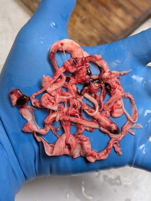 Fa21519230's tweet photo. 🚨🚨 "Han pasado 4 años y medio desde que he estado hablando públicamente sobre los extraños coágulos fibrosos blancos. Sé que muchos otros embalsamadores están viendo lo mismo. Tanta gente ha estado preguntando qué son".
Kevin McCairn ha realizado un análisis sobre ello y ha encontrado que se trata de fibrinógeno amiloidogénico. Hizo públicos sus hallazgos en un artículo de Substack"...
https://t.co/yHRQkO0koR
"Tom Havilland ha realizado un artículo basado en encuestas que él y Laura Kasner han llevado a cabo, mostrando que muchos otros morticianos están viendo el mismo fenómeno en un artículo en prepublicación listado a continuación"...
https://t.co/eNsGTPEzsJ
"Este preimpreso ha sido sometido a revisión por pares y aceptado, y estará disponible pronto".
"Me informaron temprano esta mañana que un artículo revisado por pares basado en el análisis de los coágulos ha sido aceptado por una revista y estará disponible en la próxima semana o dos".
"Los coágulos sobre los que he estado hablando se muestran más abajo"...
"Estas son solo 3 fotos tomadas este mes de junio de 2026 de cuerpos separados".
"No puedo decir con certeza si estos se forman antes o después de la muerte. No puedo decir con certeza si estos son la causa de la muerte. Todo lo que puedo decir es que existen y que no vi este tipo de coágulos antes de 2021". 
"Después de 20 años de embalsamamiento, comencé a notar estos extraños coágulos, y todavía sigo viéndolos".
"Tan pronto como obtenga el enlace al último artículo, lo compartiré"...
@r_hirschman