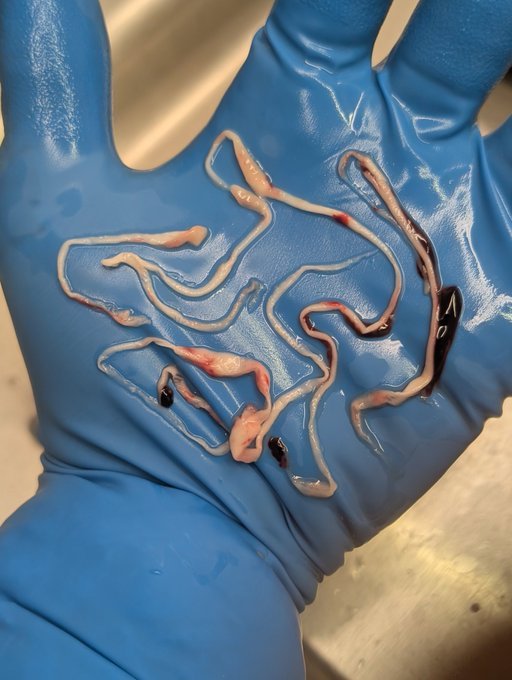 Fa21519230's tweet photo. 🚨🚨 "Han pasado 4 años y medio desde que he estado hablando públicamente sobre los extraños coágulos fibrosos blancos. Sé que muchos otros embalsamadores están viendo lo mismo. Tanta gente ha estado preguntando qué son".
Kevin McCairn ha realizado un análisis sobre ello y ha encontrado que se trata de fibrinógeno amiloidogénico. Hizo públicos sus hallazgos en un artículo de Substack"...
https://t.co/yHRQkO0koR
"Tom Havilland ha realizado un artículo basado en encuestas que él y Laura Kasner han llevado a cabo, mostrando que muchos otros morticianos están viendo el mismo fenómeno en un artículo en prepublicación listado a continuación"...
https://t.co/eNsGTPEzsJ
"Este preimpreso ha sido sometido a revisión por pares y aceptado, y estará disponible pronto".
"Me informaron temprano esta mañana que un artículo revisado por pares basado en el análisis de los coágulos ha sido aceptado por una revista y estará disponible en la próxima semana o dos".
"Los coágulos sobre los que he estado hablando se muestran más abajo"...
"Estas son solo 3 fotos tomadas este mes de junio de 2026 de cuerpos separados".
"No puedo decir con certeza si estos se forman antes o después de la muerte. No puedo decir con certeza si estos son la causa de la muerte. Todo lo que puedo decir es que existen y que no vi este tipo de coágulos antes de 2021". 
"Después de 20 años de embalsamamiento, comencé a notar estos extraños coágulos, y todavía sigo viéndolos".
"Tan pronto como obtenga el enlace al último artículo, lo compartiré"...
@r_hirschman