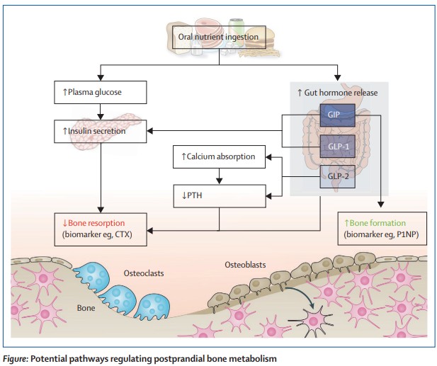 TheLancetEndo's tweet photo. The gut–bone axis: implications of gut hormone-based therapies for bone health https://t.co/3go0UhTWXi
#GLP-1 #GLP-2 #GIP
#BoneHealth #osteoporosis #fractures https://t.co/iebfFk0Ts8