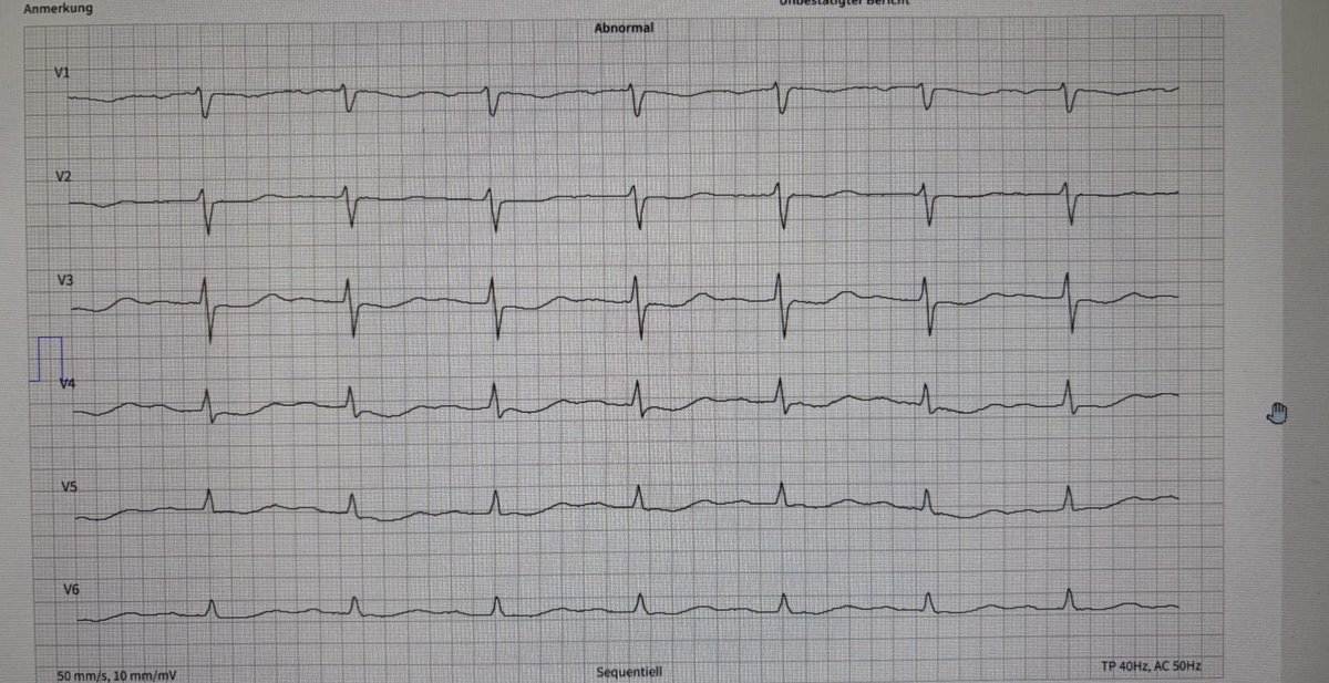 colyn_edd's tweet photo. @smithECGBlog 
@RobertHermanMD 

72 y/o female with epigastric pain radiating to jaw. First hs-Trop 0,035 ng/dl. No prior cardiac history. Went into VF and succesfully resuscitated after 1 shock. No coronary macroangiopathy in angiography. For me it was clear RCx OMI. https://t.co/wOzVGaLuRP