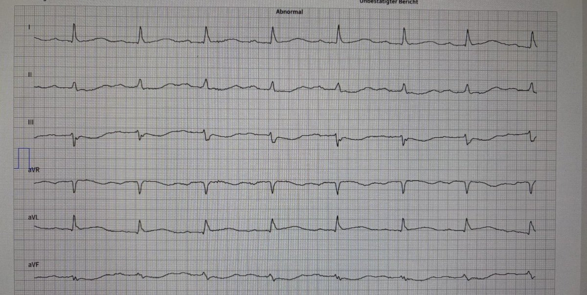 colyn_edd's tweet photo. @smithECGBlog 
@RobertHermanMD 

72 y/o female with epigastric pain radiating to jaw. First hs-Trop 0,035 ng/dl. No prior cardiac history. Went into VF and succesfully resuscitated after 1 shock. No coronary macroangiopathy in angiography. For me it was clear RCx OMI. https://t.co/wOzVGaLuRP