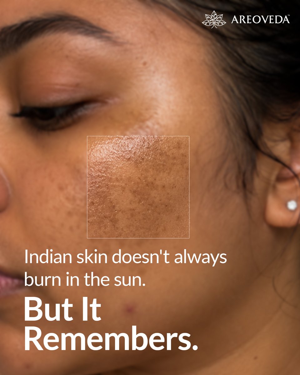 AreoVeda's tweet photo. No sunburn doesn't mean no damage! UV rays cause lasting tanning &amp; dark spots. Fade pigmentation &amp; restore your skin's natural radiance in 28 days with AreoVeda’s Skin Brightening Serum. ✨

☀️ Shop now: https://t.co/Mo5Qq42LgC https://t.co/lTprzQ6Ozh