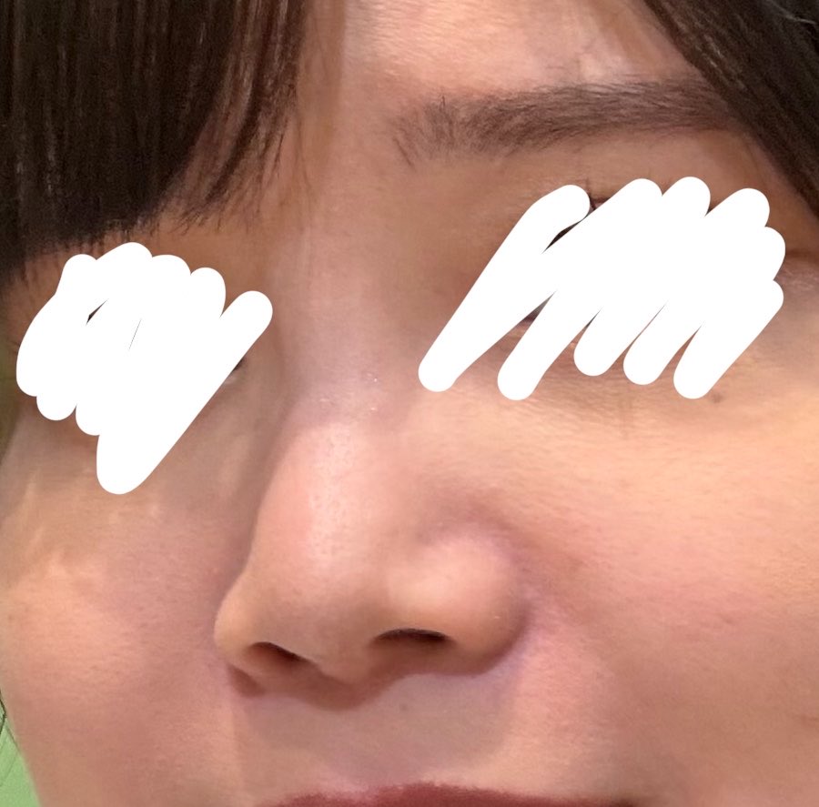 pcnwlu's tweet photo. 1枚目：鼻孔縁挙上前
2枚目：鼻孔縁挙上後

😅😅😅 https://t.co/Cp1Qw7QWNX