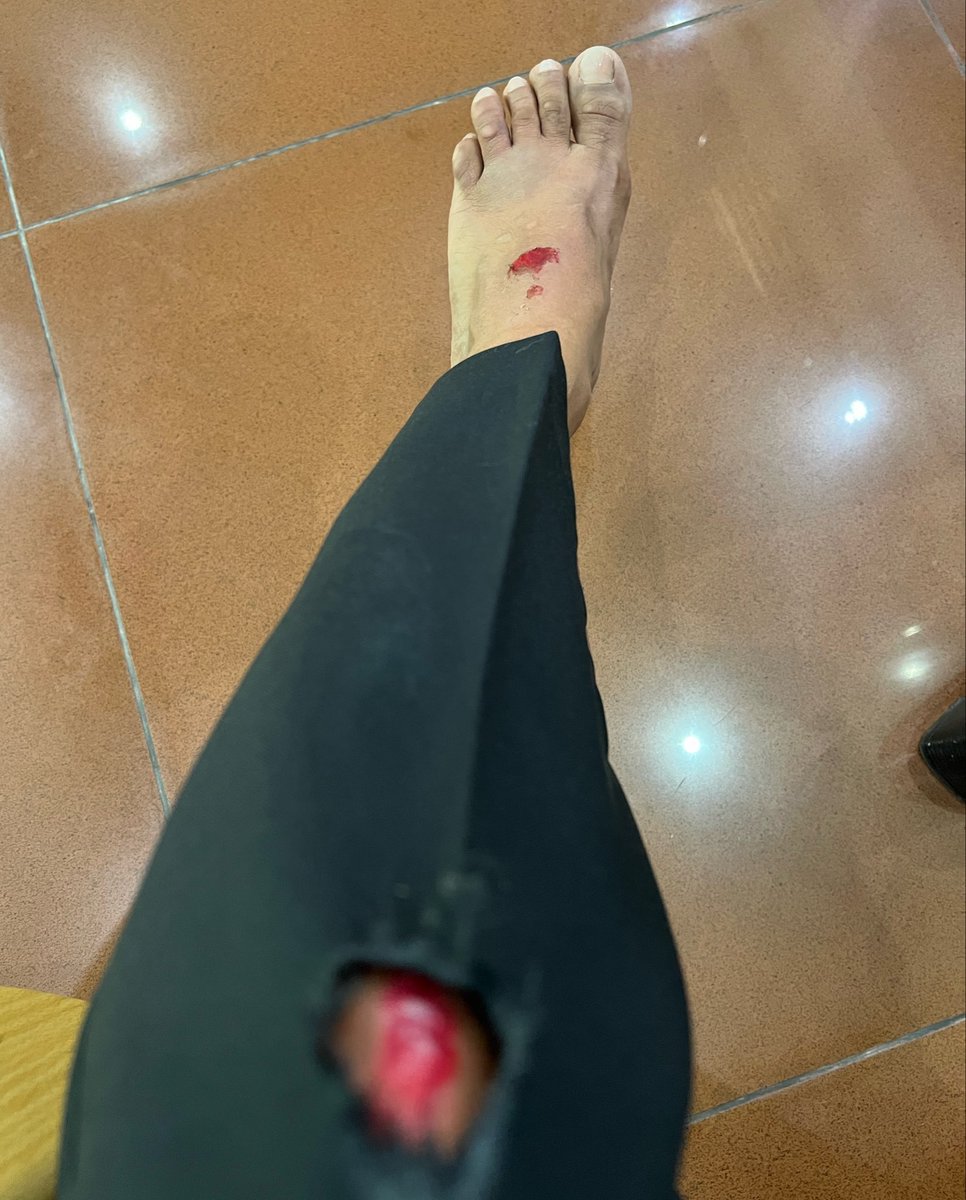 aishwajyh's tweet photo. I am beyond frustrated with the reckless behavior of some motorists on our roads. 
I was struck from behind by a motorist while I was slowing at the pedestrian crossing near Kalafaanu School on Ameenee Magu. The impact threw me across the crossing and under his motorcycle, injuring my left leg. 
This was not just an accident, it was a life-threatening incident that could have easily resulted in death. Many lives have already been lost due to reckless driving in similar situations. 
What frustrates me the most was the response at the scene. The police appeared casual, and the motorist showed little concern, despite the severity of what had just occurred.
This happened at a school crossing, while a pedestrian was crossing, an area where children and families are constantly at risk. Reckless driving here is not just careless. it is deadly.
Authorities must take this seriously. Enforce the law, hold offenders accountable, and ensure pedestrian safety before more lives are lost.
@PoliceMv