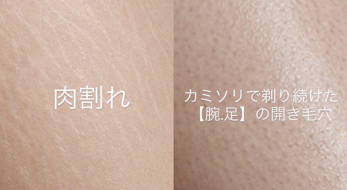 riirii_beauty's tweet photo. 脱毛サロンで働いてたけど、結局1番大事なのは毎日の保湿！肌、綺麗にしたい！肉割れ薄くしたい！って人には全力でこのクリーム使い！って伝えたい🤨

しかも、これ、鹿の間ちゃんまで高評価してんの！
これはもぉ、全女子に使って欲しい！！ https://t.co/BxFu7QFklr
