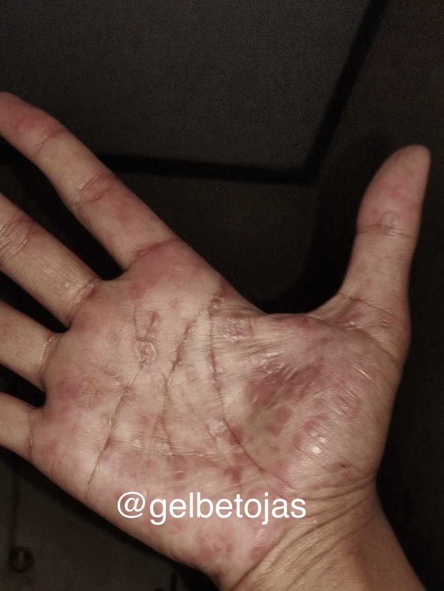 gelbetojas's tweet photo. Penting juga Cek IMS (Sifilis) rutin agar terdeteksi dini dan bisa segera diobati. Mengingat angka kasus #Sifilis di Kota Surabaya juga naik, namun di beberapa Puskesmas untuk pengecekan lanjutan dan pengobatan kosong. Ayo segera #TesVCT &amp; #TesIMS apabila ada gejala seperti ini https://t.co/Hf4vyXQU52