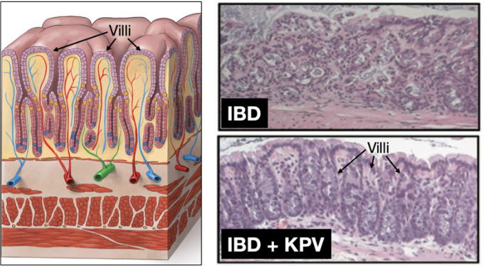 nicknorwitz's tweet photo. KPV: The Peptide that Targets Inflamed Gut Tissue Like a Smart Missile

1/5) Look at this. This is clear visual evidence of a fascinating little peptide known as KPV helping heal inflamed intestinal lining.

• Top: inflammatory bowel disease tissue: disorganized structure + inflammatory cell infiltration
• Bottom: +KPV = healthy villi return!... decreased inflammation & tissue structure normalizes

You don’t need to be a pathologist to see the difference.

But how does KPV work?