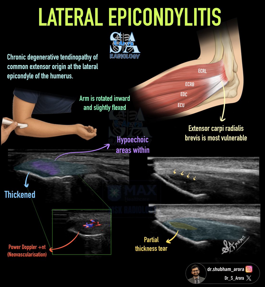 Dr_S_Arora's tweet photo. Lateral Epicondylitis:

It is the most common indication for elbow ultrasound in
our practice.
#radiology #msk #ortho #sports https://t.co/kWSuuVsw2X