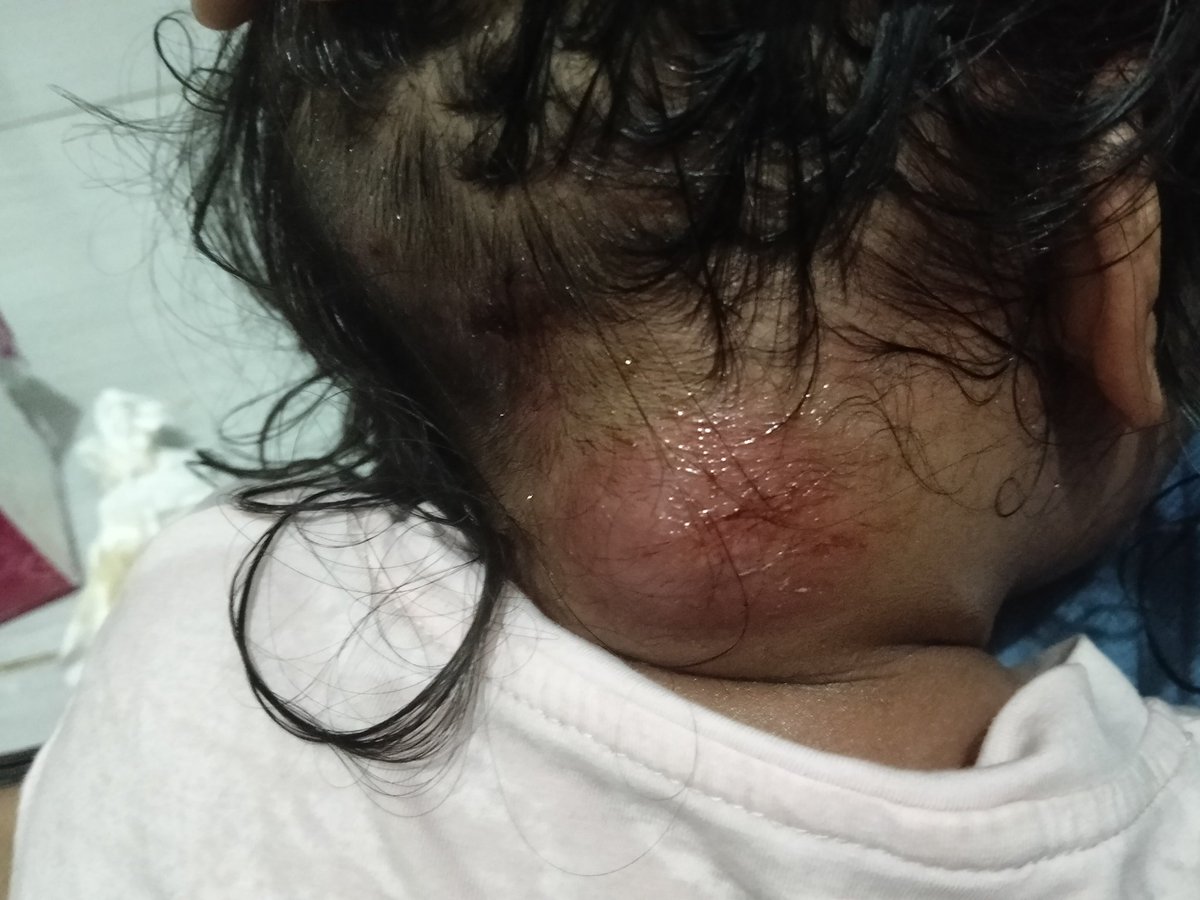 clarisanusa's tweet photo. Dan aku baru sadar setelah merhatiin cara nya berdiri dan berjalan.

Ternyata perjalanannya masih panjang nak 🥹
Ibuk kira sampe 6 bulan fisio udah kelar 
Tapi ternyata masih harus ke orthopedi

TB kelenjar dan Khyposis thoracalis https://t.co/EISW4awIpk