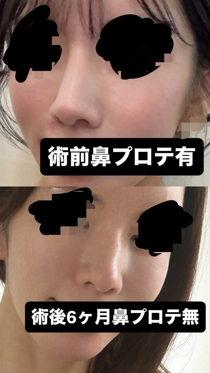 JaWkw6's tweet photo. 鼻フル＋貴族＋脂肪移植半年レポ📝

プロテ抜去で“整形しました👃”という
不自然さのある鼻の主張が消え顔に自然にに溶け込んだおかげで、今の顔の方がずっと気に入っています😭👍🏻 先生のアドバイスを聞いてよかったです✨✨✨✨ https://t.co/9cqfHSUqAj
