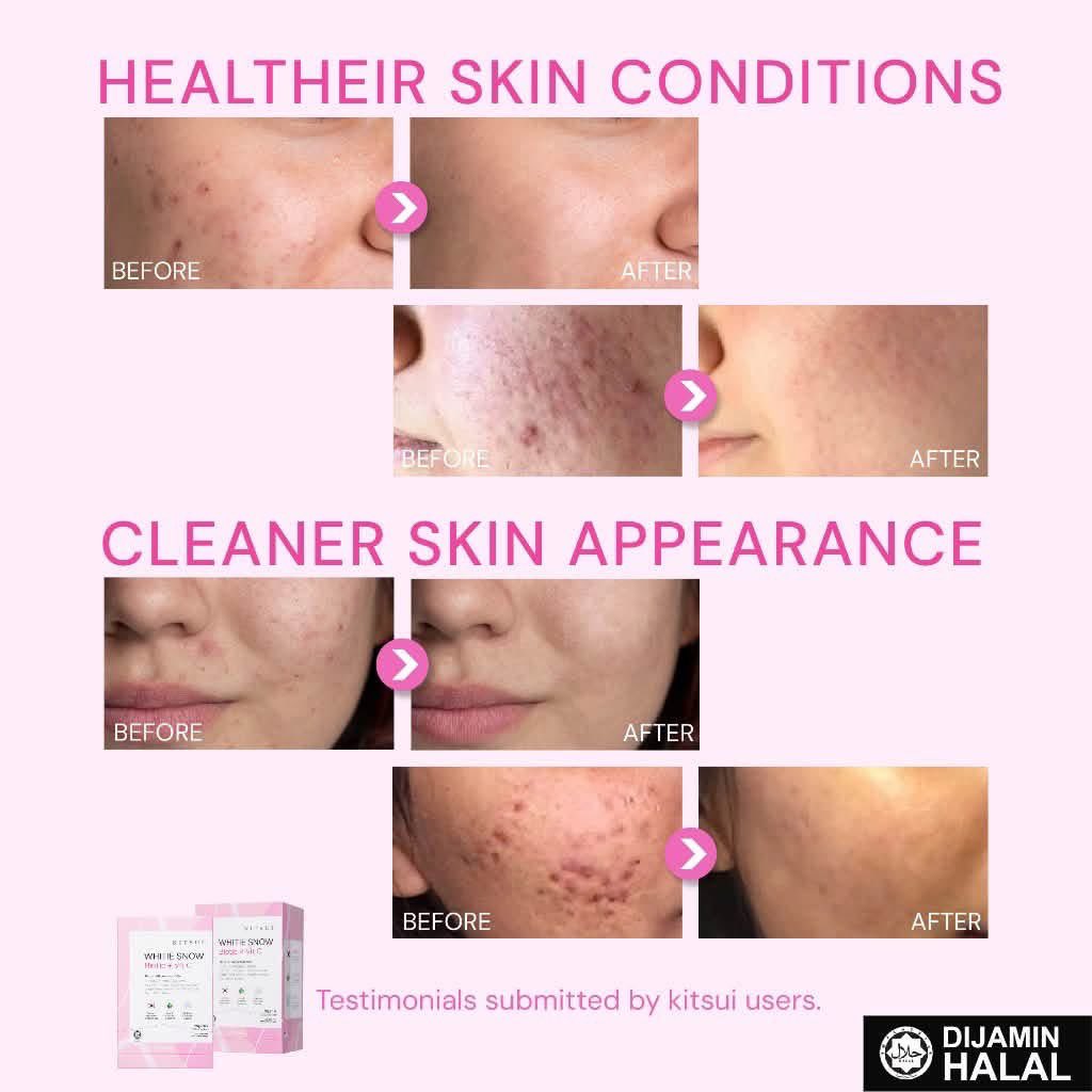info_diskaun's tweet photo. Kulit cantik bermula dari dalam! ✨

Dengan Kitsui White Snow, bantu jaga kesihatan usus sambil menikmati rutin kecantikan harian anda 😍 https://t.co/8Ytb7ftsEg