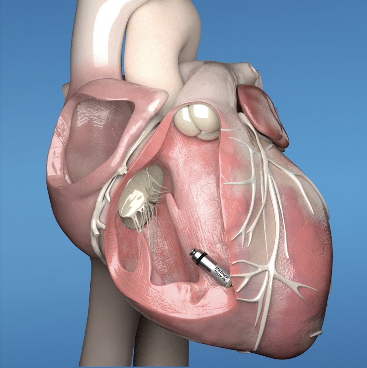 TrackYourHeart's tweet photo. Can you identify this intracardiac device?

Bonus: Name one patient who would benefit most from this device https://t.co/CyyjS9TXts