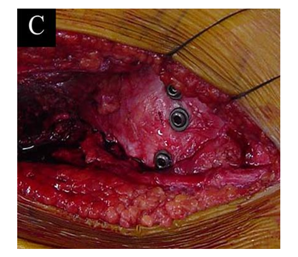 jbjs's tweet photo. "Self-Reported 20-Year Outcome of Taylor Spatial Frame Correction for Distal Femoral Physeal Growth Disturbance" by Nakazawa et al.
Read the full article π https://t.co/j3Vsgf18RD
#JBJS https://t.co/4IEOyful6b