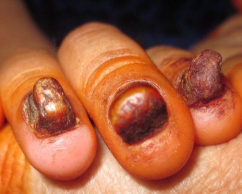 dermatology's tweet photo. 🧪 Dermatology Case

Spot diagnosis challenge! What are we looking at? ______

Answer = https://t.co/nUEG4W29MB https://t.co/uqHeuW0oFG