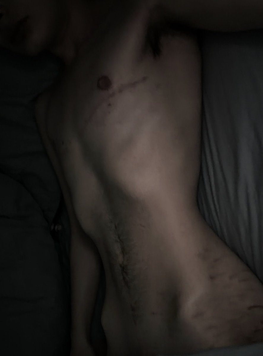onyxsjournal's tweet photo. //bodycheck 
bfs ex called me a bony bitch as an insult but it's funny bc he larps anorexia and im skinnier than him so he's literally just jealous 
#edrtwt #edtwt #shedtwt https://t.co/fAEAR2Zafn
