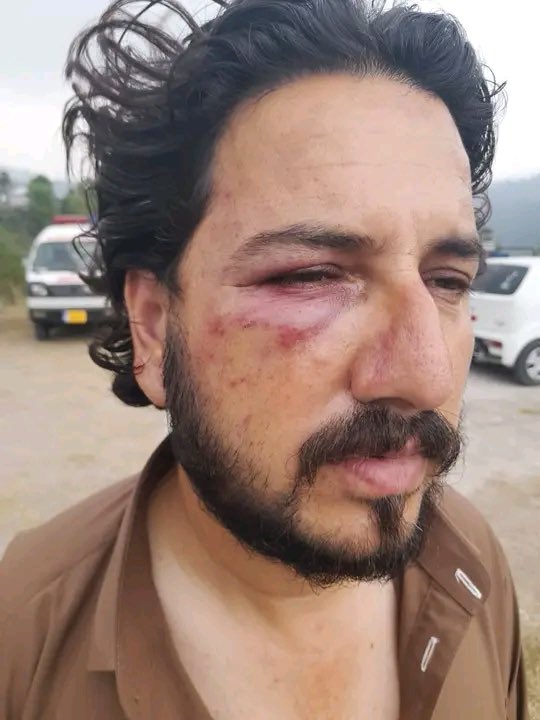 Markhor3133's tweet photo. 🚨 راولاکوٹ: احتجاج کی آڑ میں غنڈہ گردی، تاجر رہنما پر بدترین تشدد
ارجہ راولاکوٹ روڈ (جنڈالہ کراس) پر شرپسند عناصر کی بدمعاشی کا ایک انتہائی دلخراش واقعہ سامنے آیا ہے، جہاں انسانیت کو بھی شرمسار کر دیا گیا۔
واقعات کی تفصیلات:
 ایمبولنس کا راستہ بلاک: مظاہرین نے سڑک پر درخت گرا کر راستہ بند کر رکھا تھا، جس میں میت لے جانے والی ایک ایمبولنس بھی پھنس گئی۔
 راستہ دینے پر حملہ: ارجہ انجمنِ تاجران کے جنرل سیکرٹری ناصر ارباب اور ان کے کزن حسام جب ایمبولنس کو راستہ دینے کے لیے رکاوٹیں ہٹا رہے تھے، تو 20-25 مسلح افراد نے ان پر حملہ کر دیا۔
 اغوا اور بدترین تشدد: شرپسندوں نے دونوں کو اغوا کر کے گاڑی میں ڈالا اور 6 گھنٹے تک بدترین تشدد کا نشانہ بنانے کے بعد نیم مردہ حالت میں ہلاں بازار کے قریب پھینک کر فرار ہو گئے۔