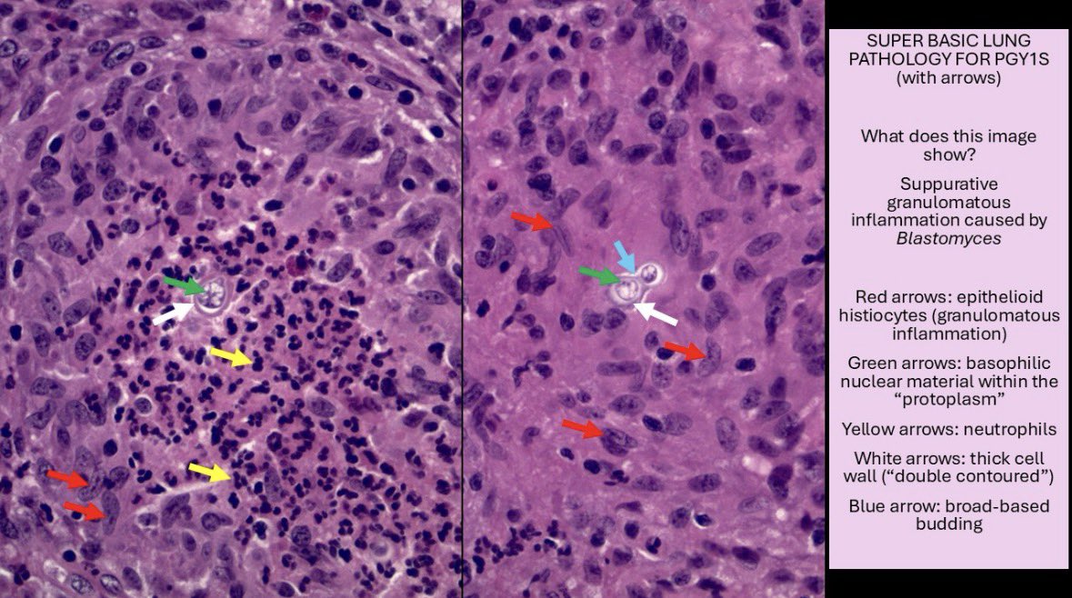 smlungpathguy's tweet photo. @Path4People @Baskotacytopath @SansanoValero @AmparoBenito @mezeitibi @raghupillappa @MdSuster @parthisandy @kis_lorand @DrAhmedKalebi @AyeshaSAzam @DrGeeONE @pembeoltulu @JMGardnerMD @kalishahillmd @IHC_guy @Williamson_SR @VijayPatho @whosainastro @shilpa29728 @ariella8 58. Blastomyces sometimes shows classic morphology and tissue reaction in histology samples, which can be pathognomonic. PGY1 #knoworfail feature: broad-based budding #pfotd
Reference: https://t.co/lXfBpVe33o https://t.co/RiwRZaGlbg
