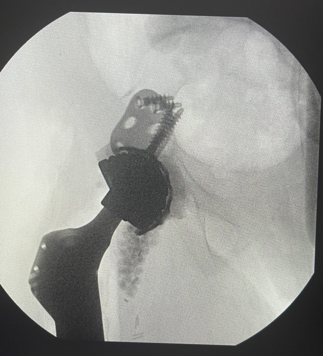 drabdullahalot's tweet photo. حالة معقدة لإستئصال ورم يوينق ساركوما Ewing Sarcoma وترميم معقد لمفصل الحوض. الحالة تمت معاينتها في العيادة وتبين أنها تم تشخيصها كحالة التهاب عضمي بالخطأ . عملت المريضة عدة عمليات خاطئة Unplanned Resections قبل الوصول إلى عيادتي. فقدت المريضة القدرة على المشي منذ ٨ أشهر قبل معاينتي لها. تم عرض خيار البتر كحل وحيد على المريضة قبل وصولها لعيادتي.

تكمن الصعوبة في مثل هذه الحالات في كون منطقة الورم ملوثة بالكامل بسبب العمليات السابقة. خيار البتر هو أحد الخيارات الشائعة التي يعمل بها لمثل هذه الحالات.

ولله الحمد والمنة، تمت مناقشة خيار الحفاظ على الطرف مع العائلة وبدأت رحلة العلاج وتكللت بالنجاح. 

الآن ولله الحمد، المريضة تشافت تماما من السرطان/الساركوما وحافظت على طرفها السفلي بشكل كامل وجميع الأعصاب والشرايين تم الحفاظ عليها . كذلك المريضة تعافت واستعادت حركة المشي ولله الحمد وفي طريقها الى أن تعيش حياة طبيعية خالية من السرطان بإذن الله.

العمل كفريق واحد كان أهم عامل لنجاح هذه الحالة. الشكر الكبير للدكتور غازي الثبيتي والدكتور عادل حلمي من جراحة التجميل على مساعدتهم في ترميم الأنسجة الرخوة للمريضة.

في الردود رابط لمزيد من الصور الإكلينيكية والشرح في حسابي بمنصة انستاقرام.

ودمتم بصحة وسلامة دائما