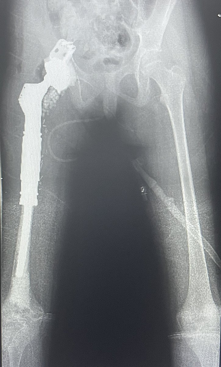 drabdullahalot's tweet photo. حالة معقدة لإستئصال ورم يوينق ساركوما Ewing Sarcoma وترميم معقد لمفصل الحوض. الحالة تمت معاينتها في العيادة وتبين أنها تم تشخيصها كحالة التهاب عضمي بالخطأ . عملت المريضة عدة عمليات خاطئة Unplanned Resections قبل الوصول إلى عيادتي. فقدت المريضة القدرة على المشي منذ ٨ أشهر قبل معاينتي لها. تم عرض خيار البتر كحل وحيد على المريضة قبل وصولها لعيادتي.

تكمن الصعوبة في مثل هذه الحالات في كون منطقة الورم ملوثة بالكامل بسبب العمليات السابقة. خيار البتر هو أحد الخيارات الشائعة التي يعمل بها لمثل هذه الحالات.

ولله الحمد والمنة، تمت مناقشة خيار الحفاظ على الطرف مع العائلة وبدأت رحلة العلاج وتكللت بالنجاح. 

الآن ولله الحمد، المريضة تشافت تماما من السرطان/الساركوما وحافظت على طرفها السفلي بشكل كامل وجميع الأعصاب والشرايين تم الحفاظ عليها . كذلك المريضة تعافت واستعادت حركة المشي ولله الحمد وفي طريقها الى أن تعيش حياة طبيعية خالية من السرطان بإذن الله.

العمل كفريق واحد كان أهم عامل لنجاح هذه الحالة. الشكر الكبير للدكتور غازي الثبيتي والدكتور عادل حلمي من جراحة التجميل على مساعدتهم في ترميم الأنسجة الرخوة للمريضة.

في الردود رابط لمزيد من الصور الإكلينيكية والشرح في حسابي بمنصة انستاقرام.

ودمتم بصحة وسلامة دائما